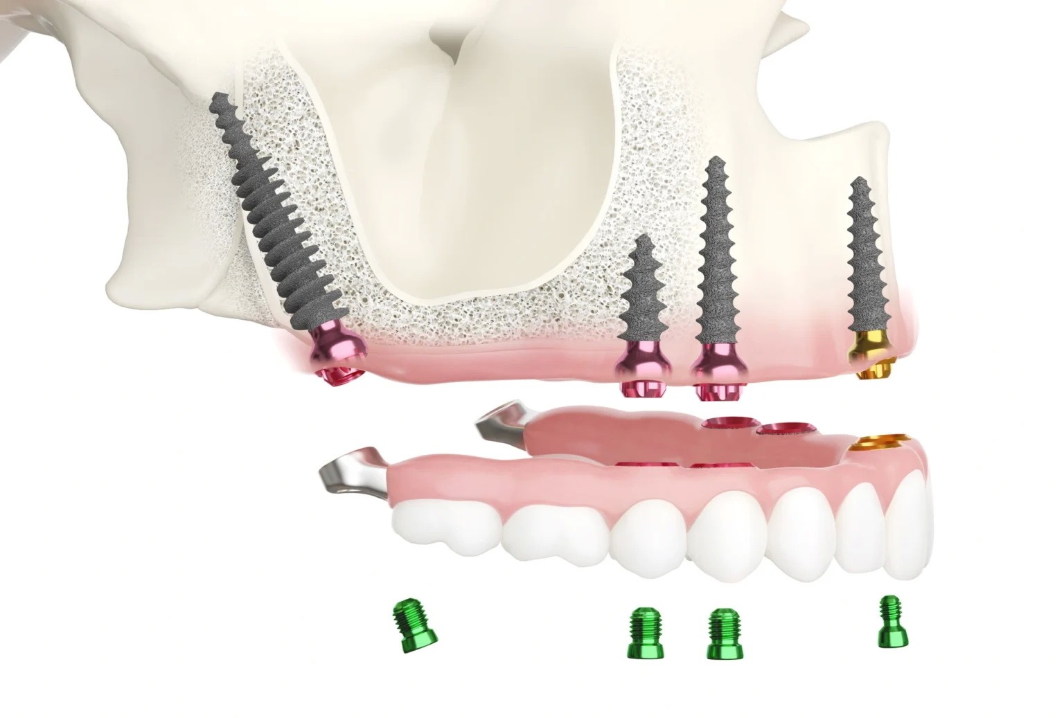 Cosa Sono Gli Impianti Dentali E A Cosa Servono Implantologia