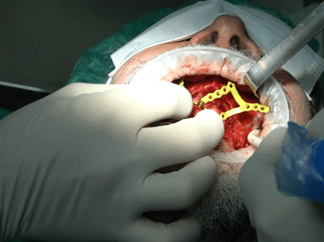 Implantologia Sottoperiostea